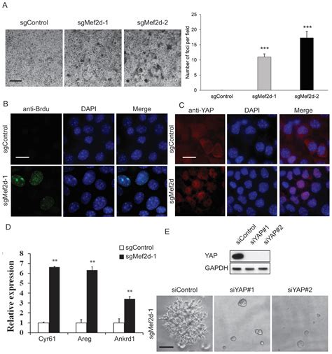 MEF2D Functions as a Tumor Suppressor in Breast Cancer