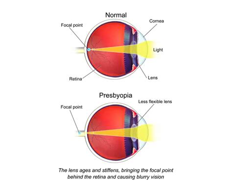 Presbyopia and Myopia