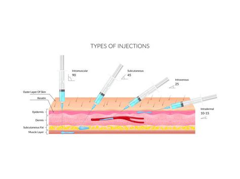 Injection Types 的图像结果