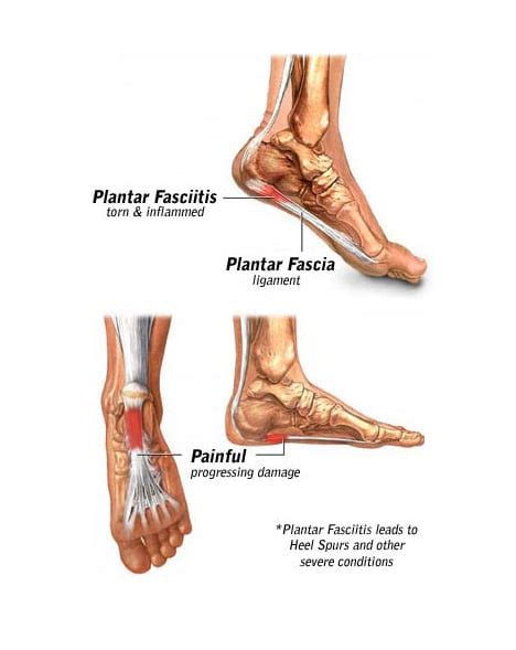 Plantar Fasciitis 的图像结果