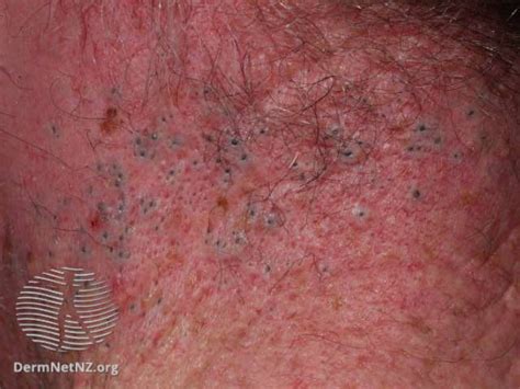 Image result for Solar Comedones Extraction