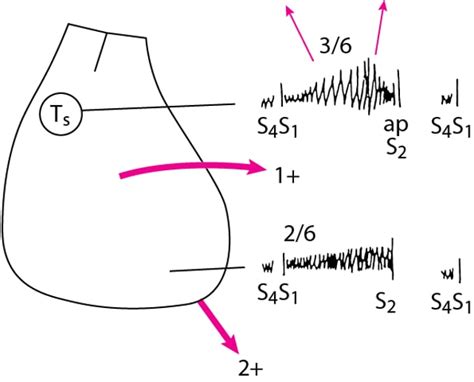 Cardiac Auscultation - Cardiac Auscultation - MSD Manual Professional ...