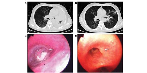 Trans‑bronchoscopy with implantation of 125I radioactive seeds in ...