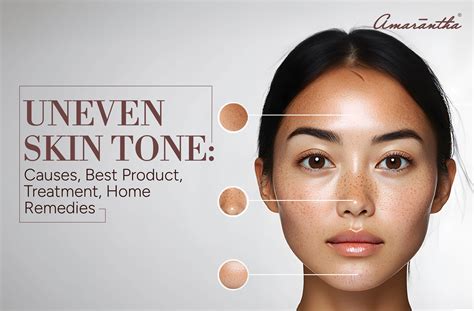 Uneven Skin Tone: Causes, Product, Treatment & Remedies