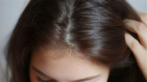 Scalp Parasites 的图像结果