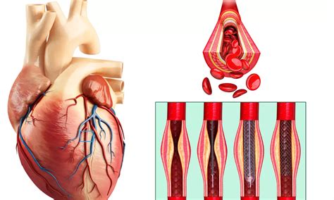 Coronary Arterial Aneurysms of small size, recent onset and diagnosed ...