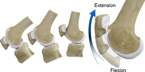 Patellar Tracking: An Old Problem with New Insights | RadioGraphics