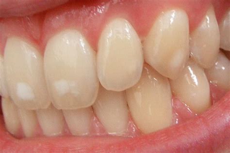 Image result for Tooth Stain
