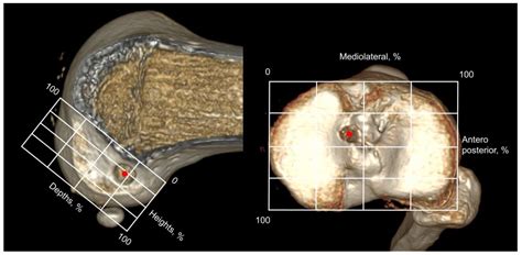 Femoral Tunnel Position Affects Postoperative Femoral Tunnel Widening ...