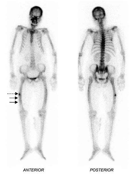 Image result for Radionuclide Scan