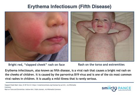 Fifth Disease Rash