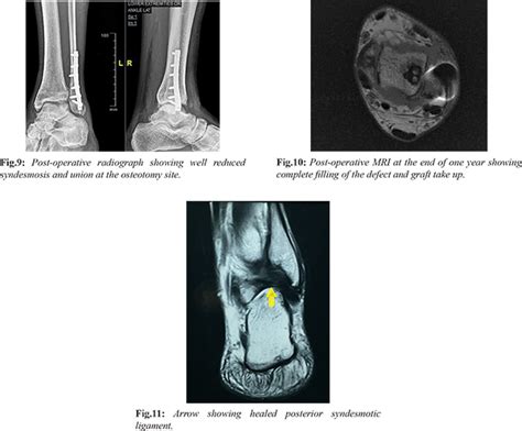 Mosaicplasty by a Modified Lateral Malleolus Osteotomy Approach for ...