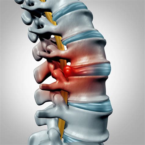 Can Herniated Discs Heal on Their Own? | Spine-health