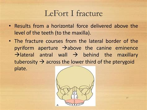 Le Fort Fractures | PDF