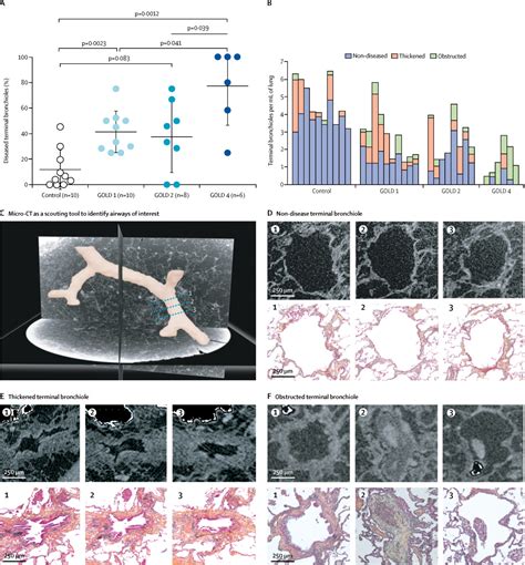 Small airways disease in mild and moderate chronic obstructive pulmonary disease: a cross ...