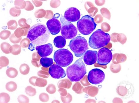 Image result for Lymphocyte Precursor