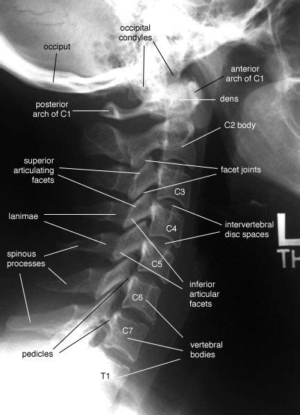 Radiology Anatomy Images : Cervical Spine - Lateral View X-Ray anatomy
