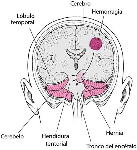 Hernia cerebral - Hernia cerebral - Manual MSD versión para público general