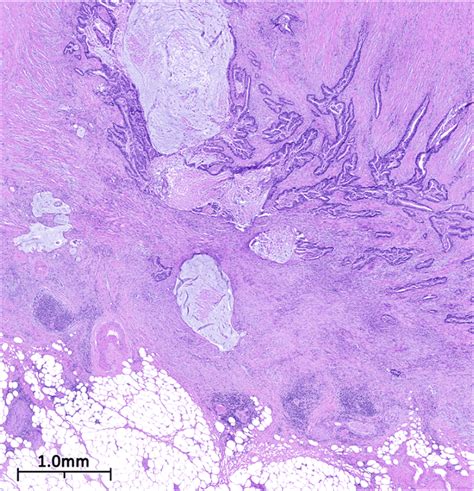 Image result for Dissected Appendix