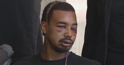 Man hit by projectile during Dallas protest speaks out after losing ...