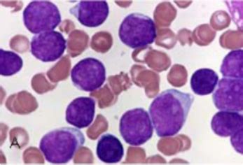Lymphoid and Myeloid Neoplasms Flashcards | Quizlet