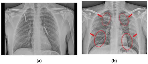 Fast COVID-19 and Pneumonia Classification Using Chest X-ray Images