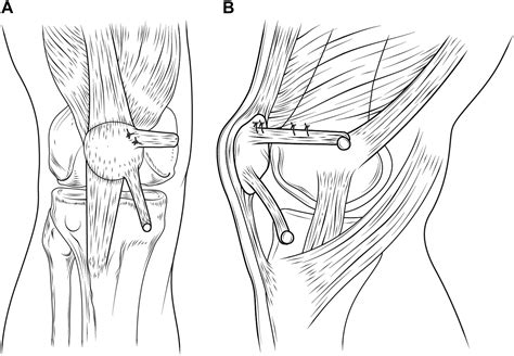 Combined Reconstruction of the Medial Patellofemoral Ligament With Quadricipital Tendon and the ...