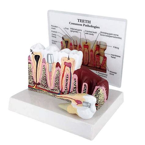Zjhcc Teeth Cross Section Model Gums Model Anatomy Teeth Model ...
