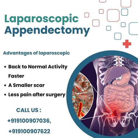 Laparoscopic Appendectomy Laparoscopic Appendectomy • MEDtube.net