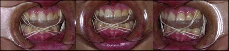 Image result for Intermaxillary Fixation