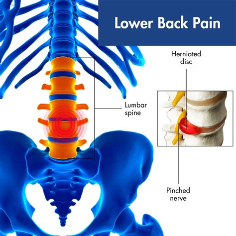 Image result for Left Lower Back Muscle Strain