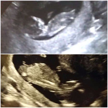 Stacked nub? Help! | BabyCenter