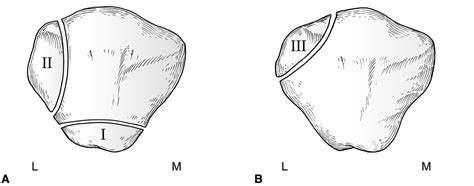 Bipartite Patella - Pediatrics - Orthobullets