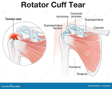 Rotator Cuff Tear Shoulder Illustration. Labeled Stock Illustration - Illustration of humerus ...