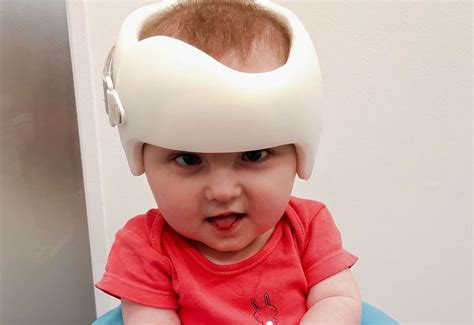 Special helmet for Gillingham tot born with flat-head syndrome