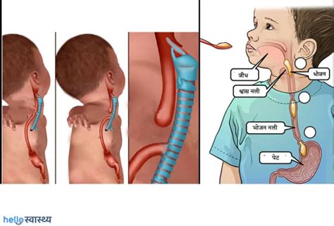 Tracheoesophageal Fistula : ट्रैचियोइसोफैगल फिस्टुला क्या है? - हैलो ...