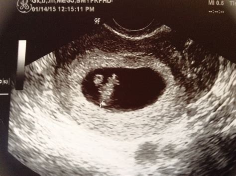 8 Week Ultrasound Heartbeat
