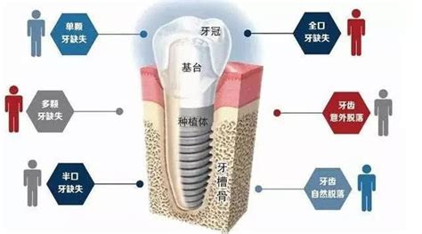 瑞士ITI种植牙怎么样?_种植牙知识-深圳爱康健口腔医院