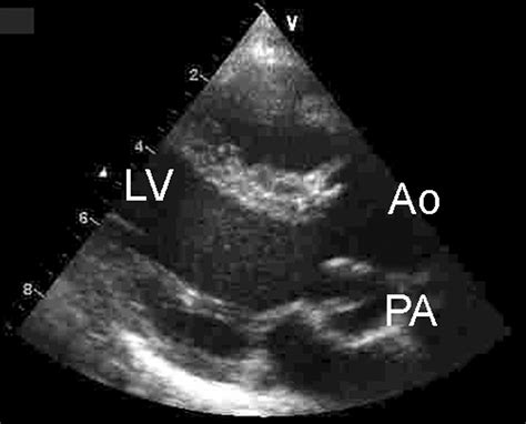 Double-Outlet Left Ventricle | Circulation