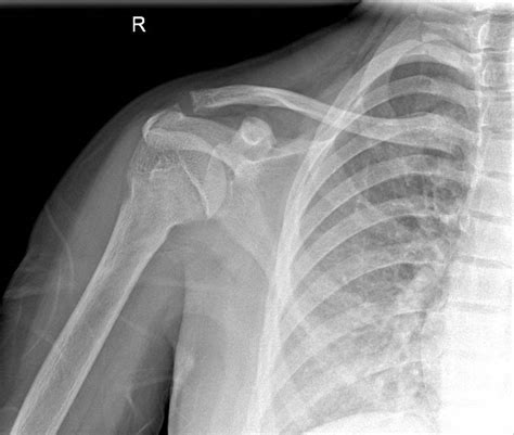 X Ray Normal Shoulder