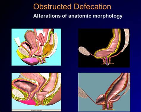 Image result for Obstructive Defaecation
