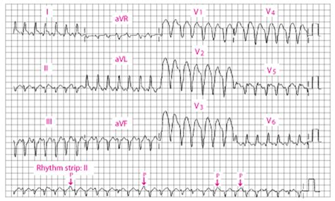 Ventricular Tachycardia (VT) - Ventricular Tachycardia (VT) - MSD ...