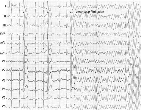 Ventricular Fibrillation (VF) - Ventricular Fibrillation (VF) - MSD ...