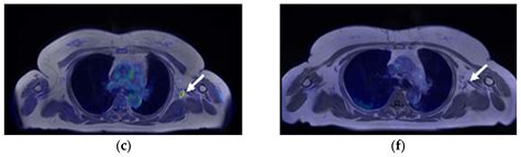 [18F]FES PET Resolves the Diagnostic Dilemma of COVID-19-Vaccine ...