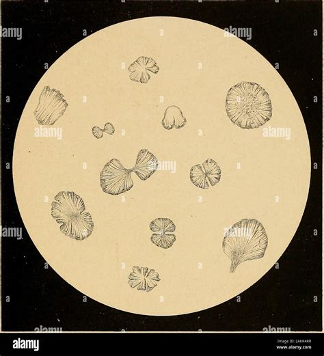 Uric acid crystals hi-res stock photography and images - Alamy