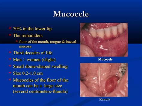 Salivary gland pathology | PPT