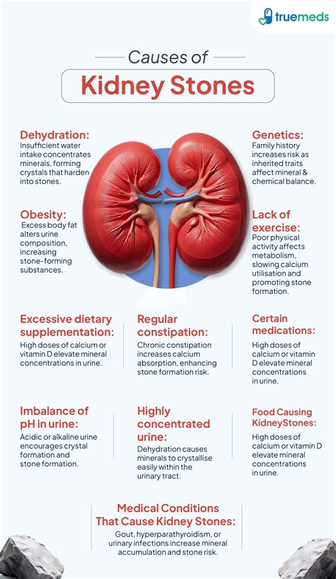 Kidney Stones: Causes, Symptoms & Treatment