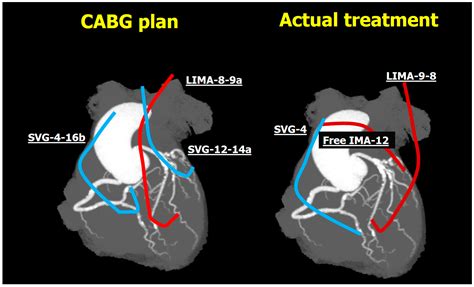Discordance between Invasive and Non-Invasive Coronary Angiography: An In-Depth Functional and ...
