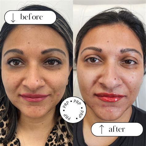PRP Under Eye Treatment in Niagara | Reduce Dark Circles & Puffiness — NP Medical Niagara
