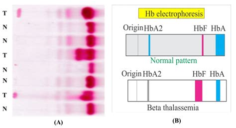 Electrophoresis Blood Test Results at Ruby Osborne blog